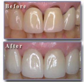 Implant restoration example