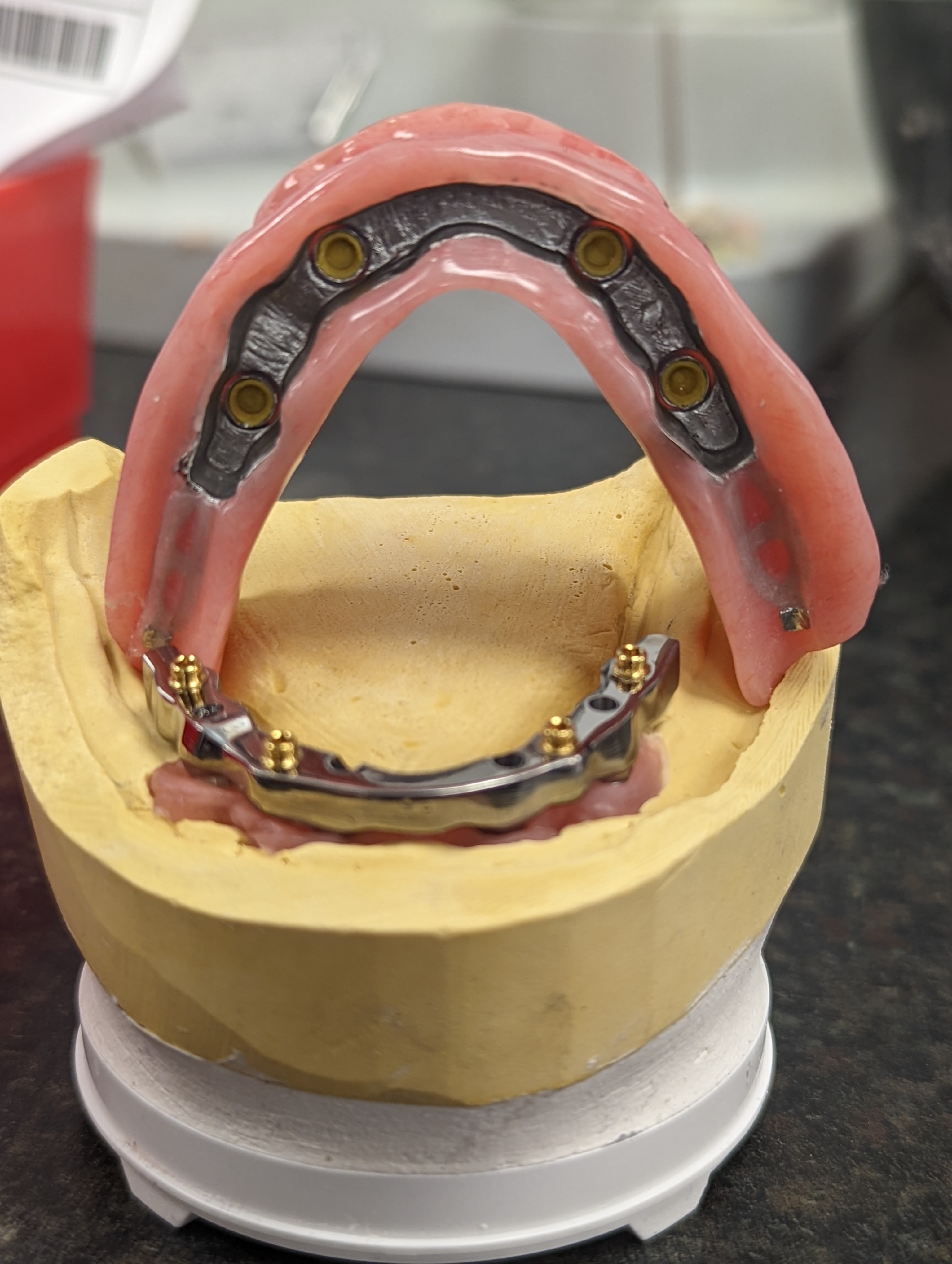 Implant restoration example photo