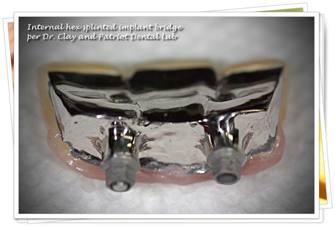 Implant restoration close up