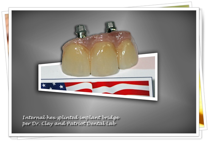 Implant restoration case photo