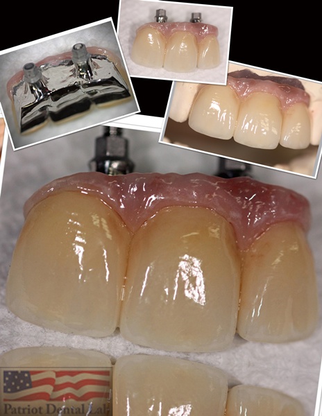 Implant restoration collage