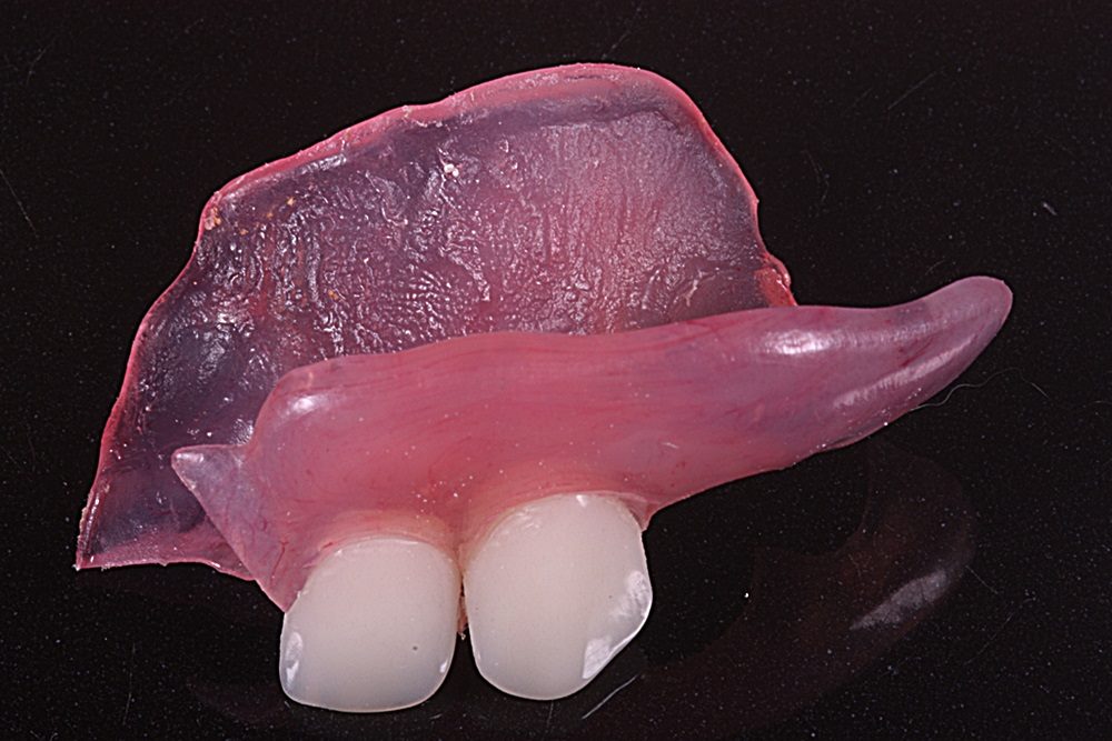 Partial denture